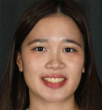 after smile correction treatment